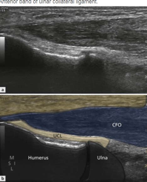 Quick Guide To Diagnostic Ultrasound Of The Elbow Sports Medicine Review