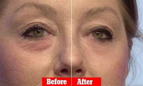 Share More Than 64 Botox For Under Eye Bags Super Hot Induhocakina