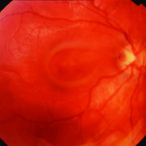 A Fundus Photograph Of The Right Eye Showing The Optic Disc Pit And
