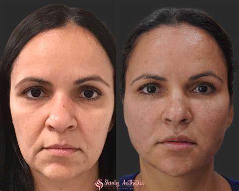 Pdo Thread Lifting Before And After Results At Skinly Aesthetics