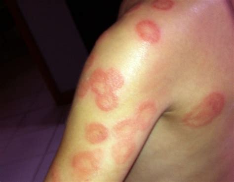 Nummular Eczema Pictures Treatment Causes Symptoms Diagnosis