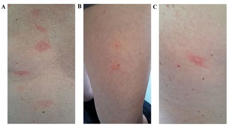 Diffuse Nettle Rash After The Infusion Of Anti Pdl1 Therapy Which