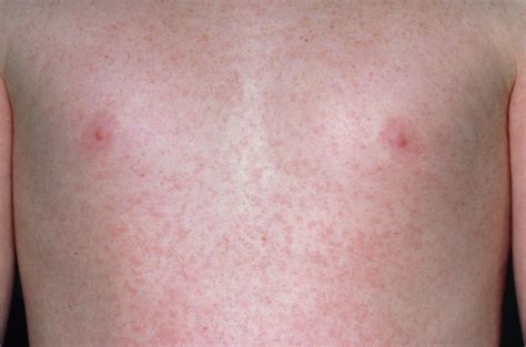 Rubella And Staphylococcal Scalded Skin Rashes