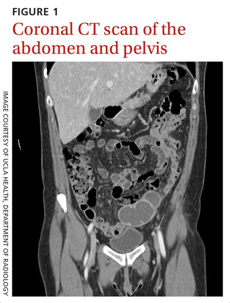 Fever Abdominal Pain And Adnexal Mass MDedge Family Medicine