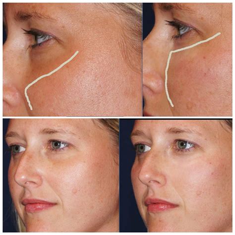 Dermal Fillers Charlotte Nc At The Skin Center By Cps