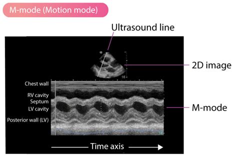 M Mode Motion Mode Echocardiography Ecg And Echo