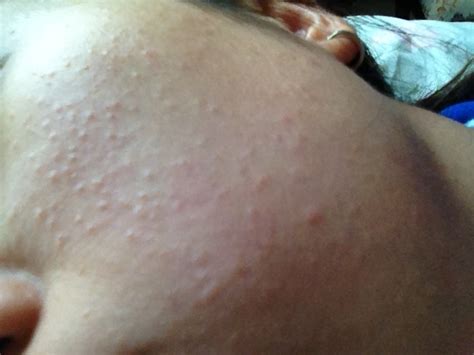 What Are The Small Bumps On My Face Dorothee Padraig South West Skin