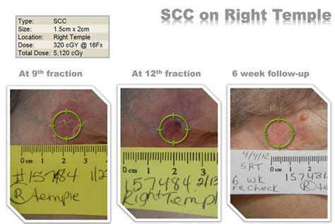 Srt For Skin Cancer Atlanta Dermatology And Laser Surgery