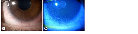 A Slit Lamp Examination Left Eye Showed Conjunctival Hyperemia