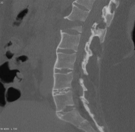 Ankylosing Spondylitis Chalk Stick Fracture Image