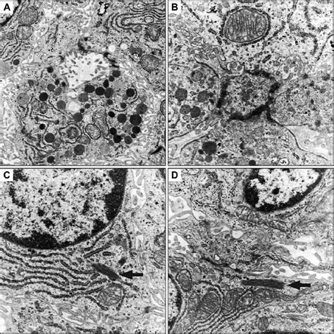 Ultrastructural Features Of The Acinar Cell Carcinoma A Acinar Cells