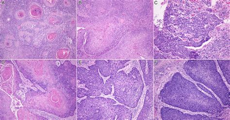 Histopathological Grading Of Oral Squamous Cell Carcinoma Showing