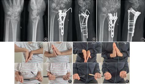 Corrective Osteotomy With Volar And Dorsal Fixation For Malunion Of