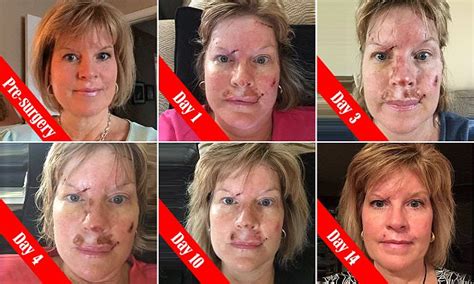 This Is What Skin Cancer Looks Like Woman Shows Damaging Effects Of