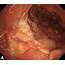 Primary Localized Amyloidosis Of The Duodenum  Clinical