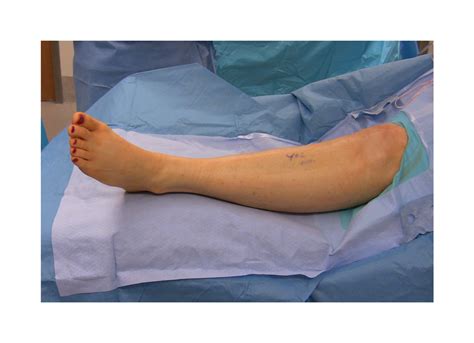 Common Peroneal Nerve Release At The Fibular Head Surgical Education