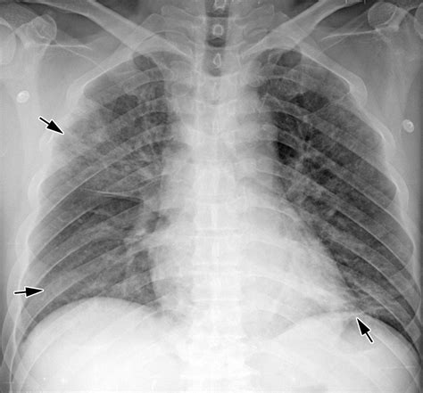 Radiographic And Ct Features Of Viral Pneumonia Radiographics