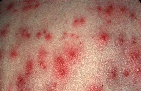 Eosinophilic Folliculitis Medical Pictures Info Health Definitions