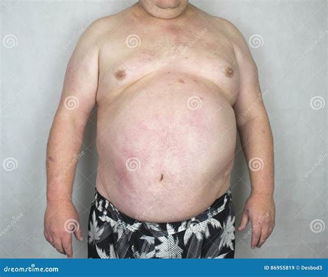 Obésité homme obèse image stock Image du diabétique 86955819