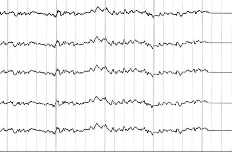 The Eeg Shows Symmetric Well Regulated Reactive Background Activities