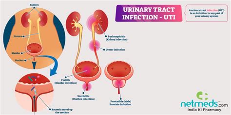 Urinary Tract Infection Uti Causes Symptoms And Treatment
