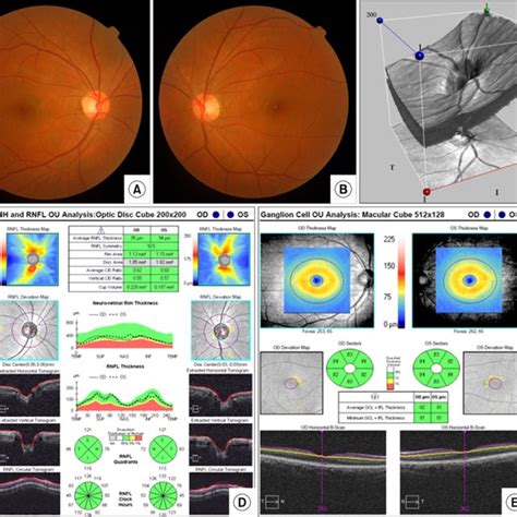 Optic Disc Photograph And Sd Oct Of Naion In The Acute Stage A The