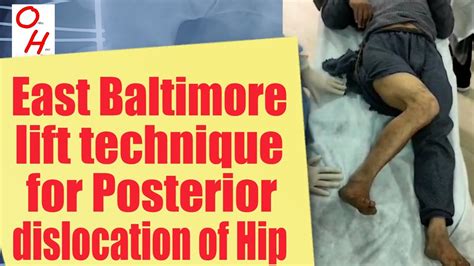 How To Reduce A Hip Dislocation Or A Dislocated Hip Youtube