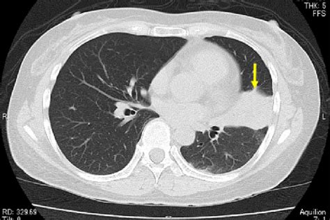 Chest Ct Showed A Tumor Shadow In The Lingual Portion Of The Left Upper