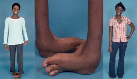 Two Very Different Clubfoot Treatments Boston Childrens Answers