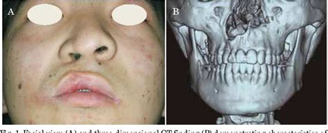 Figure From Surgical Strategy For Secondary Correction Of Unilateral And Bilateral Cleft Lip