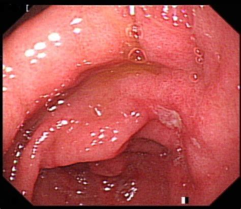 Peptic Ulcer Causes Symptoms And Treatments