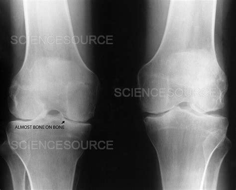 Rheumatoid Arthritis X Ray Stock Image Science Source Images