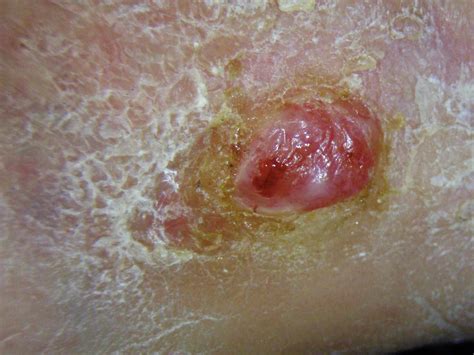 Skin Cancer Overview And More