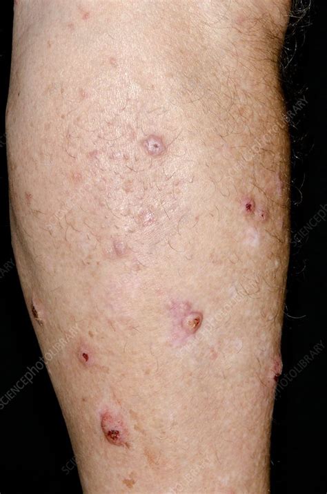 Nodular Prurigo On The Skin Stock Image C0142701 Science Photo