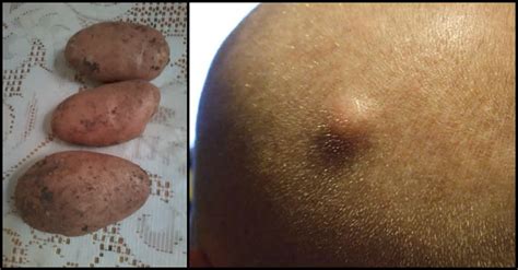 Sebaceous Cysts Heres How To Safely Get Rid Of Them At Home