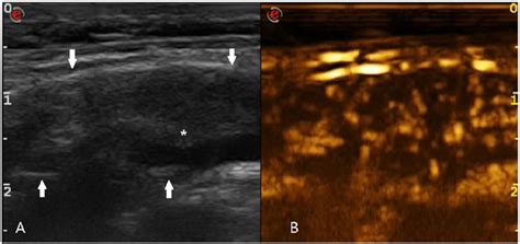 Gray Scale Ultrasound Examination Of The Suspicious Lymph Node