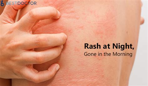 Coronavirus Symptoms Rash