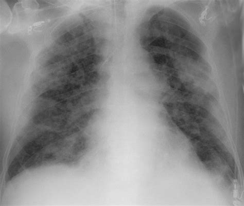 Covid 19 Pneumonia And Covid 19 Associated Acute Respiratory Distress