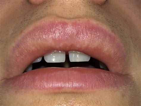 Small White Spots On Lips After Filler