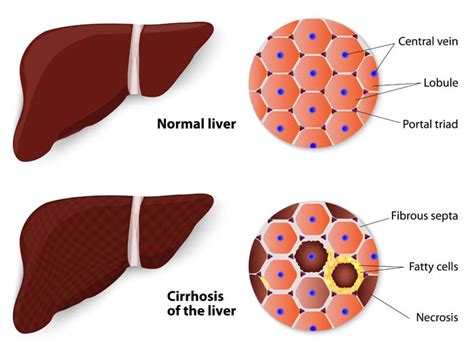 • acute or chronic • focal or diffuse • mild or severe • reversible or irreversible. Liver Cirrhosis | Asian American Liver Centre
