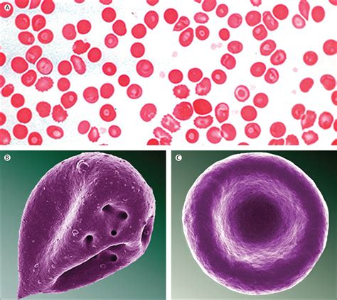 The Effect Of Iron Overload On Red Blood Cell Morphology The Lancet