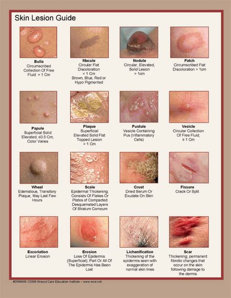 Dont Be Rash About Deadly Rashes — Maimonides Emergency Medicine Residency