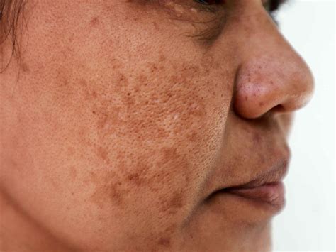 Manchas en la piel Cómo eliminarlas y cuándo acudir al dermatólogo