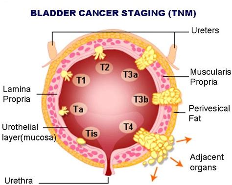 Cancer Treatment Method What Is Bladder Cancer