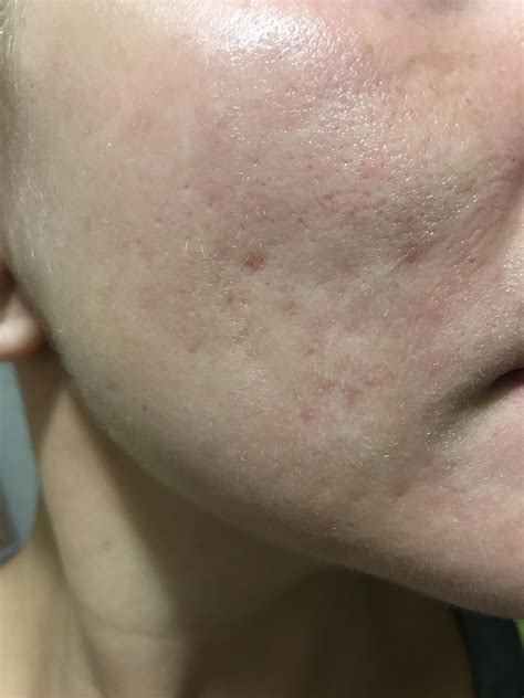 How Do I Heal These Red Acne Scars Hyperpigmentation Reddark