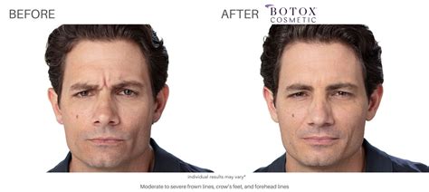 Botox And Dysport Fda Cleared Safe And Effective For Fine Lines And Wrinkles
