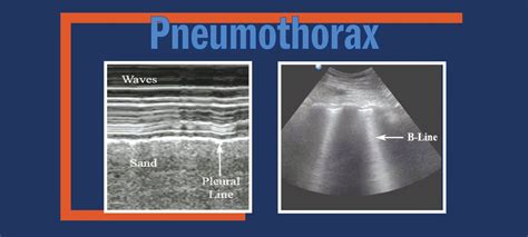 Pneumothorax Pocus Resources And Case Studies