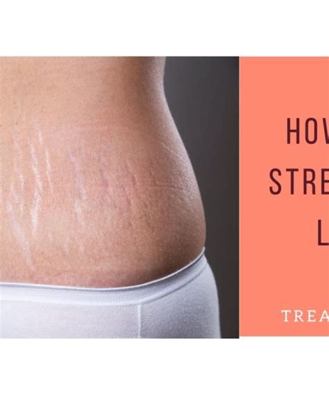 Stretch Marks Archives Treat Your Scars