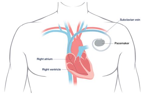 Pacemaker Conditions And Treatments Ucsf Health