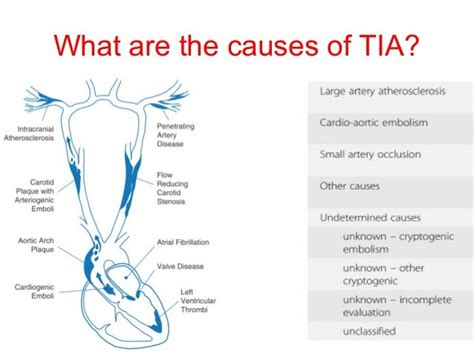 What Is A Transient Ischemic Attack Tia